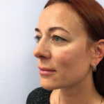 Верхняя блефаропластика - до