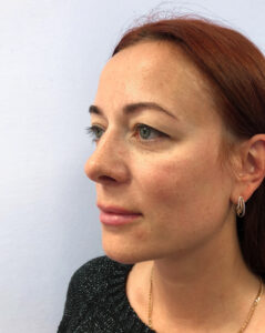 Верхняя блефаропластика - до