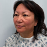 Верхняя блефаропластика - до