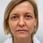 Верхняя блефаропластика - до