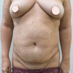 Абдоминопластика - до