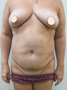 Абдоминопластика - до