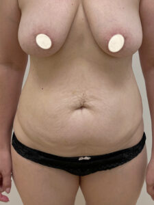 Абдоминопластика - до