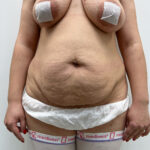 Абдоминопластика - до