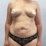 Абдоминопластика - до