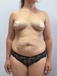 Абдоминопластика - до