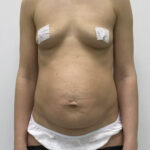 Абдоминопластика - до