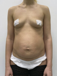 Абдоминопластика - до