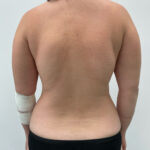 Липосакция - до