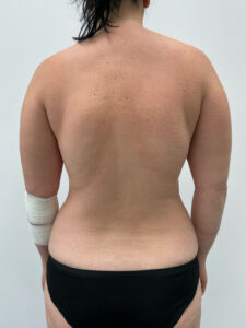 Липосакция - до