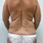 Липосакция - до