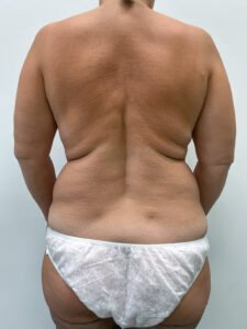 Липосакция - до