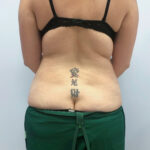 Липосакция - до