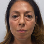 Эндоскопический лифтинг с блефаропластикой - до