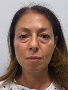 Эндоскопический лифтинг с блефаропластикой - до