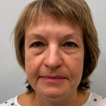 Эндоскопический лифтинг с блефаропластикой - до