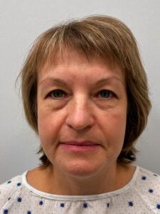 Эндоскопический лифтинг с блефаропластикой - до