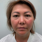 Эндоскопический лифтинг с блефаропластикой - до