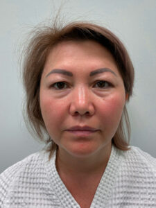 Эндоскопический лифтинг с блефаропластикой - до