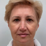 Эндоскопический лифтинг с блефаропластикой - до