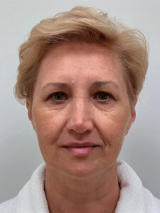 Эндоскопический лифтинг с блефаропластикой - до