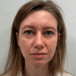 Эндоскопический лифтинг с блефаропластикой - до