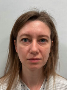 Эндоскопический лифтинг с блефаропластикой - до