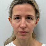 Эндоскопический лифтинг с блефаропластикой - до