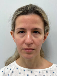 Эндоскопический лифтинг с блефаропластикой - до