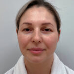 Эндоскопический лифтинг с блефаропластикой - до