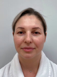 Эндоскопический лифтинг с блефаропластикой - до