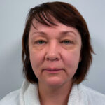 Эндоскопический лифтинг с блефаропластикой - до