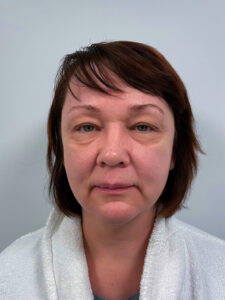 Эндоскопический лифтинг с блефаропластикой - до