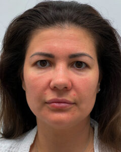 Круговая блефаропластика - до