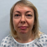 Круговая блефаропластика - до