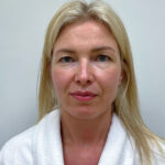 Круговая блефаропластика - до