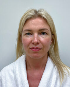 Круговая блефаропластика - до