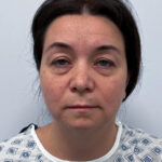 Круговая блефаропластика - до