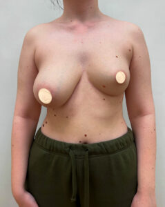 Маммопластика подтяжка - до