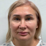 СМАС лифтинг - до