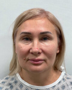 СМАС лифтинг - до