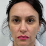 Верхняя блефаропластика - до