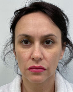 Верхняя блефаропластика - до