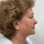 СМАС лифтинг - до