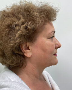 СМАС лифтинг - до