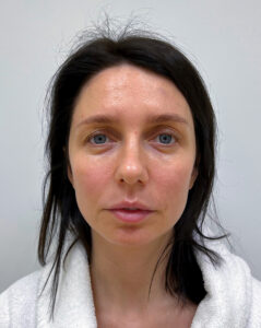 Эндоскопический лифтинг с блефаропластикой - до