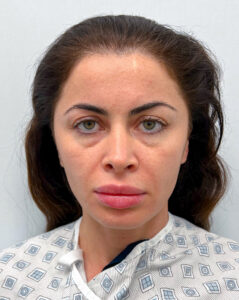 Эндоскопический лифтинг с блефаропластикой - до