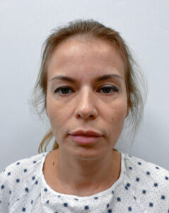 Верхняя блефаропластика - до