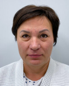 Смас с круговой блефаропластикой - до