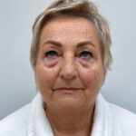 Круговая блефаропластика - до